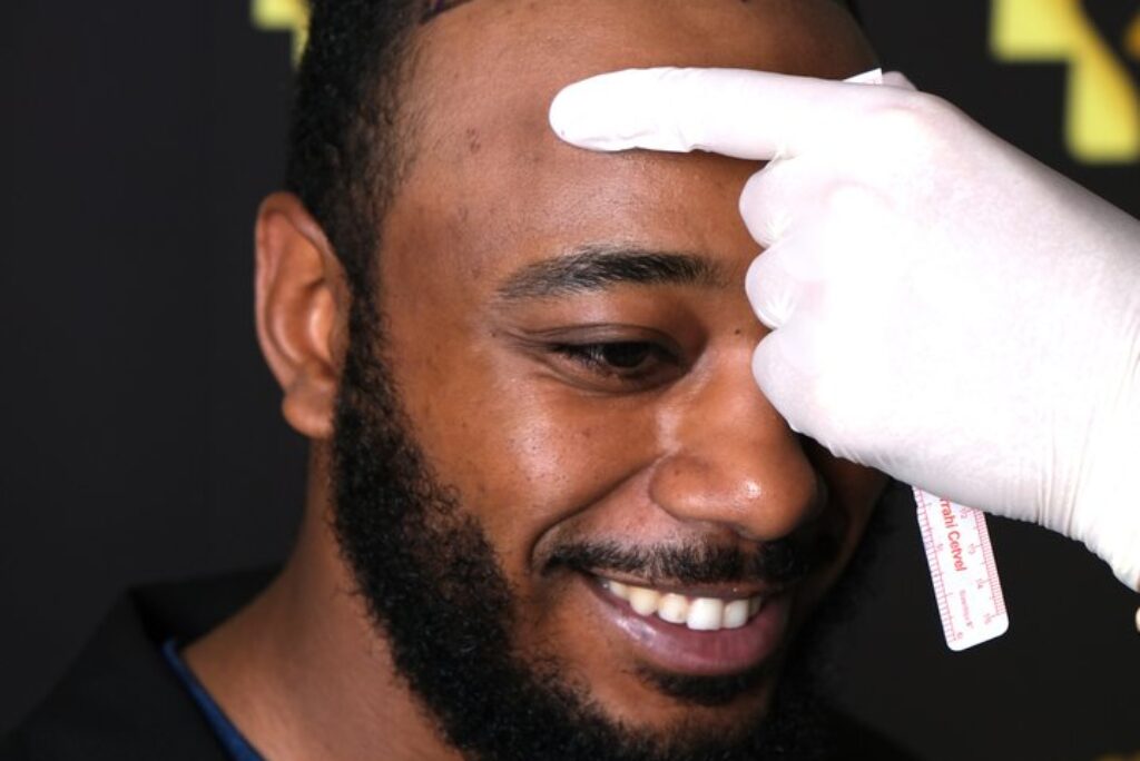 Hair Transplant in Turkey: Why It’s a Global Destination for Hair Restoration